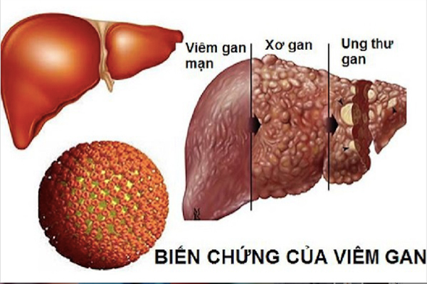 Thông báo về việc tổ chức Hội thảo khoa học cập nhật đào tạo liên tục chuyên đề: “Tiếp cận và Điều trị Bệnh lý Viêm gan B và Viêm gan C” năm 2022